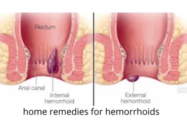 बवासीर क्या है, कारण और उपचार | बवासीर के घरेलू उपचार | बवासीर के लक्षण और उपचार | Bawaseer Karan or Upchar in Hindi |home remedies for hemorrhoids